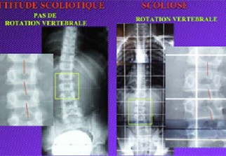 comment reparer scoliose
