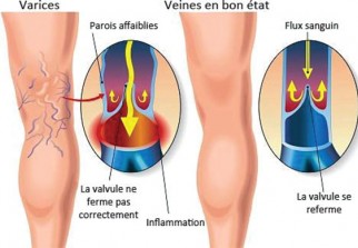 varice scleroterapie
