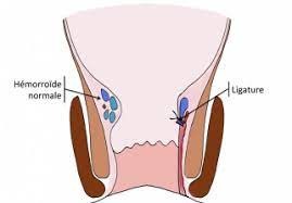 Les manifestations de la crise hémorroïdaire