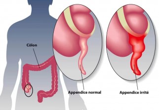 Santé : Mal au ventre : et si c'était l'appendicite ?