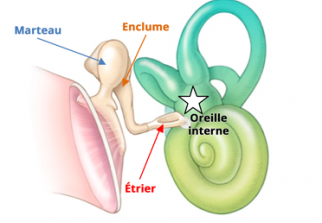 Santé : Otospongiose quelle est cette maladie de l'oreille interne